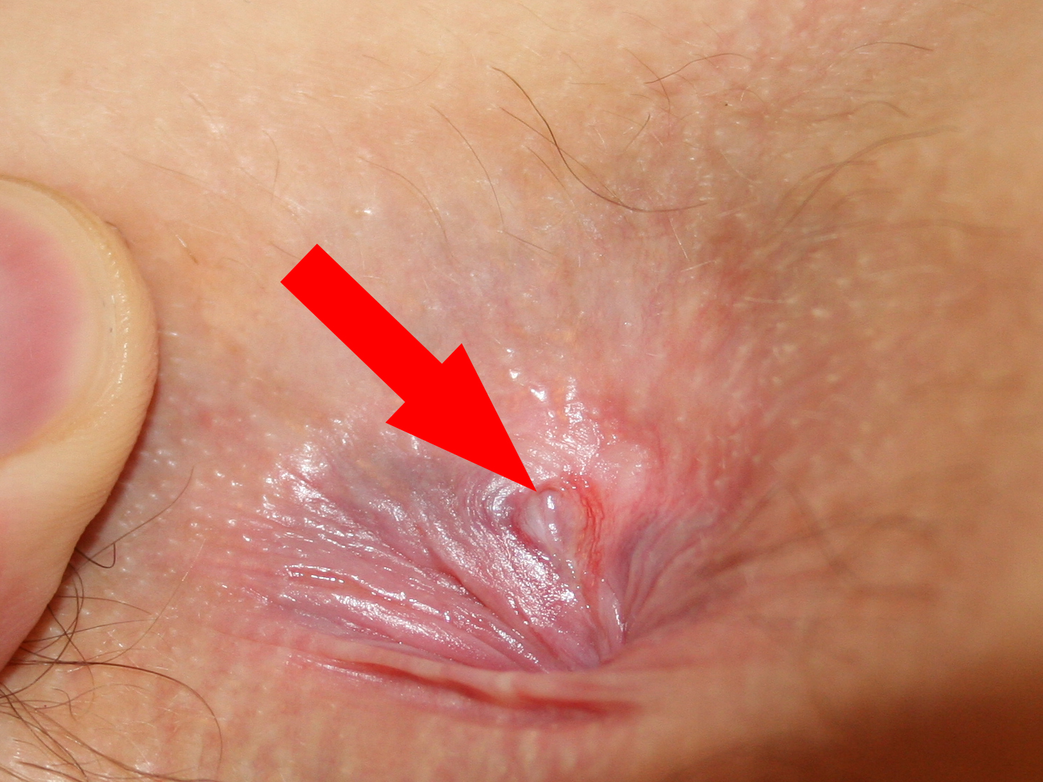 anal